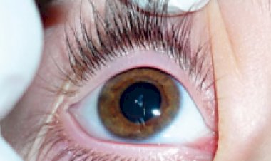 Estados Unidos: Colírios contaminados causam 4 mortes